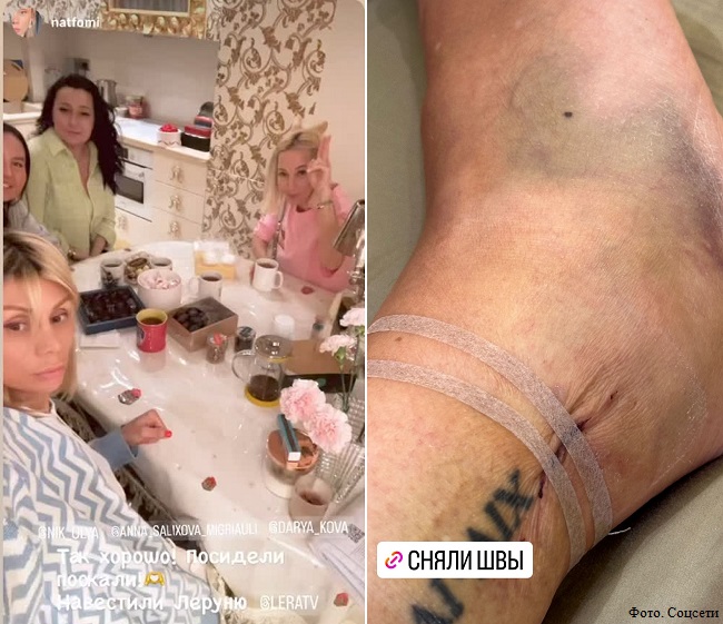 Лера Кудрявцева повеселилась с подругами и показала больную ногу