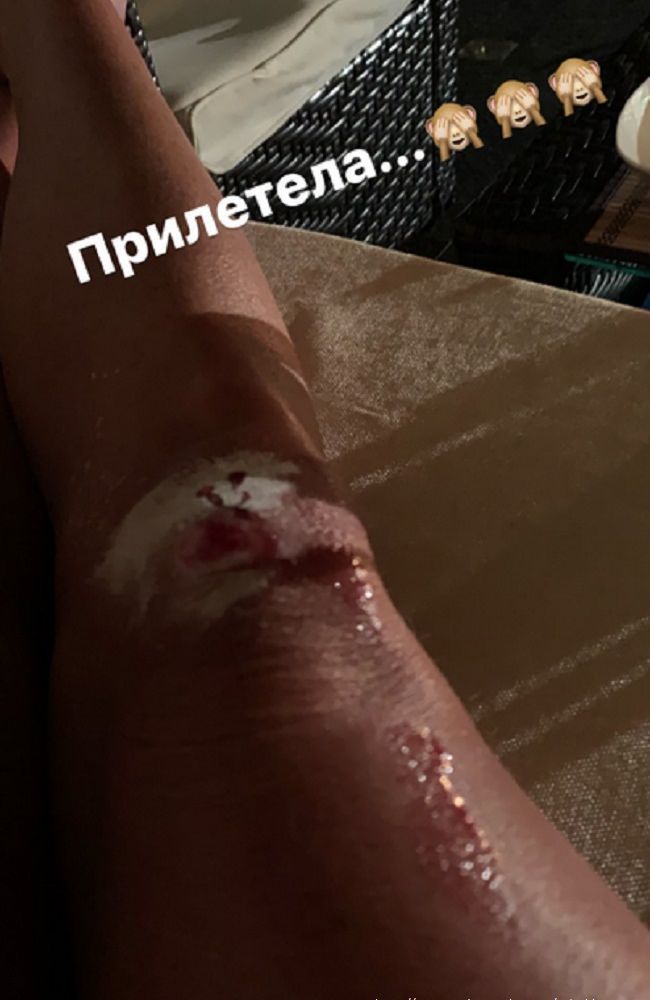 Анастасия Волочкова показала разбитое колено 